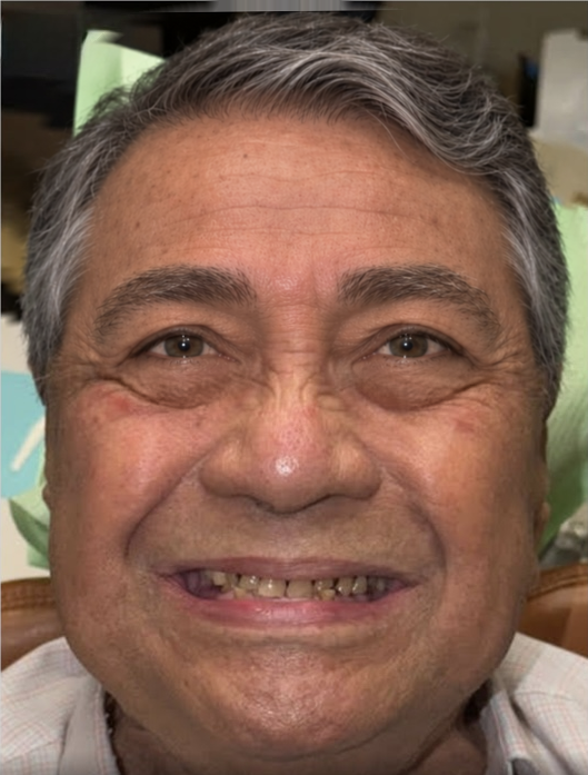 Una sonrisa frente al desgaste. · antes